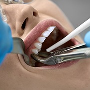 Close-up of patient’s mouth during tooth extraction in Pepper Pike, OH