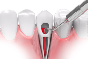 Illustration of root canal therapy being performed